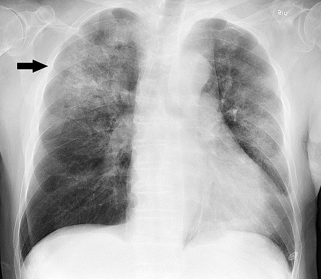 640px Chest radiograph in influensa and H influenzae posteroanterior annotated