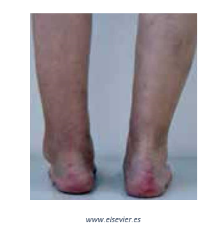 Artrosis tobillo 2