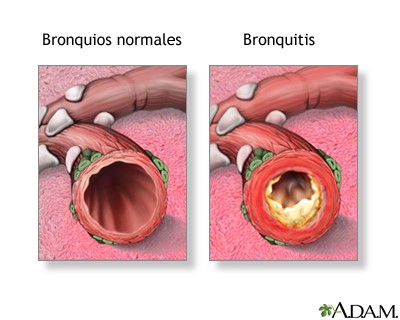 Bronquitis1